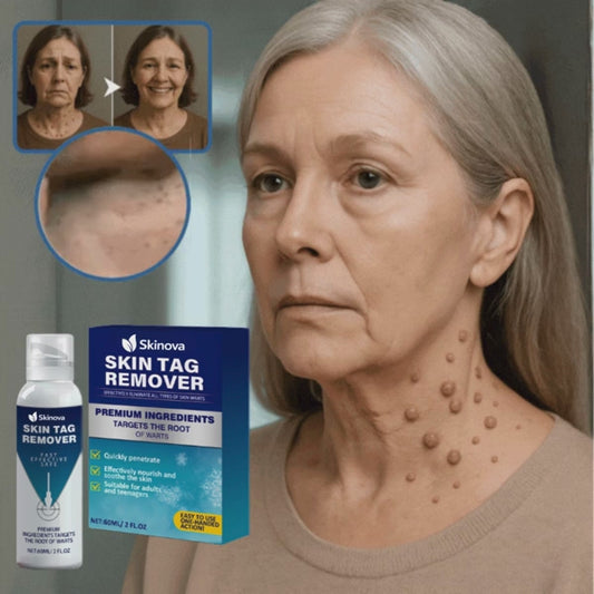 Skinova™ syylävoide | Sileä ja syylätön iho pysyvästi – jopa 4 päivässä!